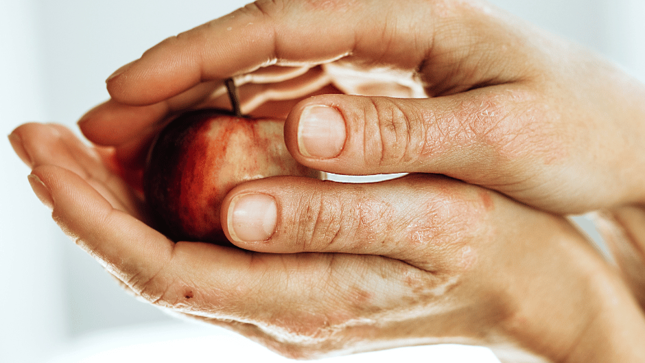 KAMI auch bei Psoriasis? Ja, natürlich, dank dieser Inhaltsstoffe