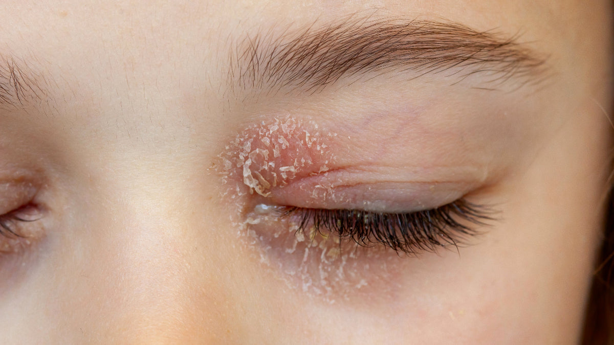 Dermatitis im Gesicht