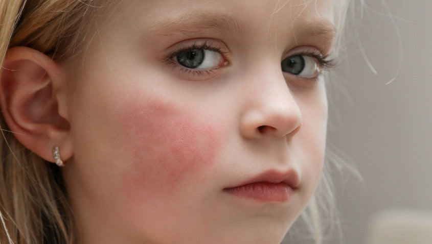 Kinderhaut im Herbst & Winter: Ursachen und Pflege trockener und juckender Haut