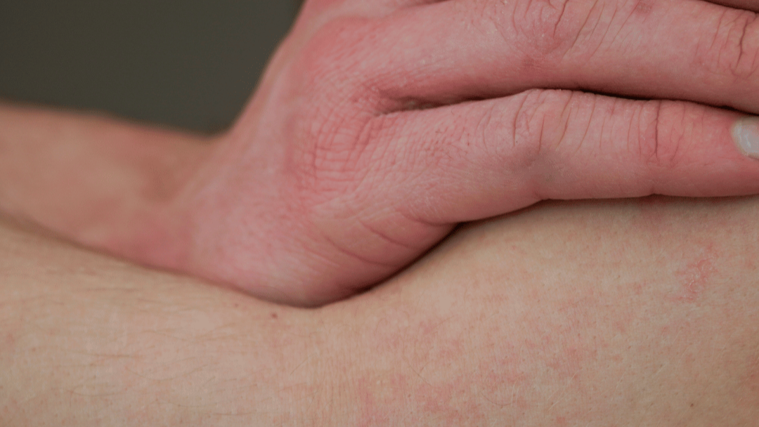 Trigger für Neurodermitis