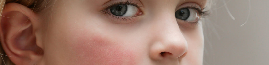 Kinderhaut im Herbst & Winter: Ursachen und Pflege trockener und juckender Haut