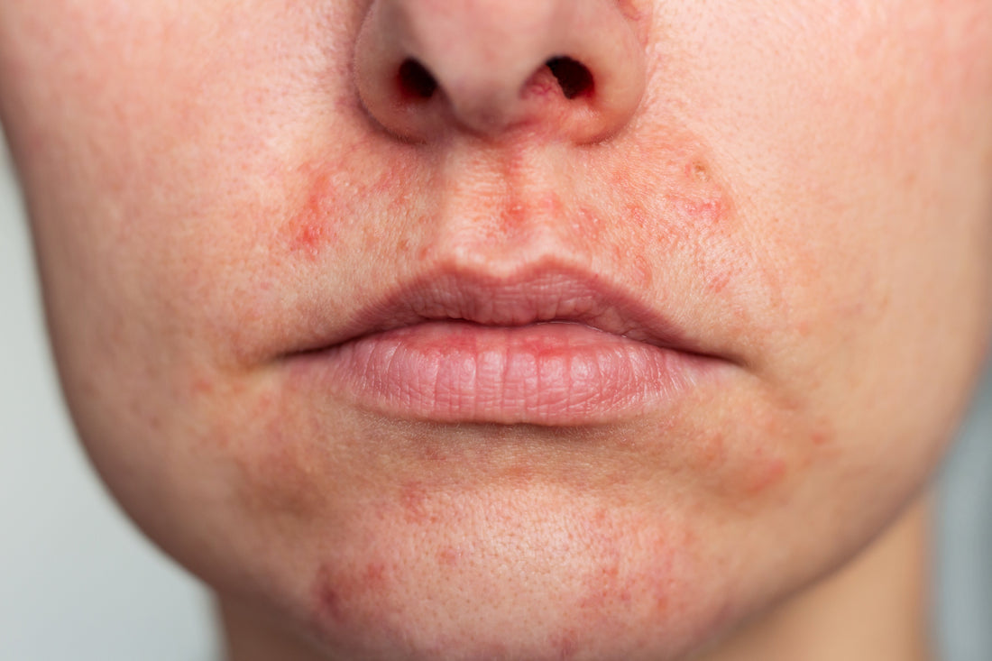 Periorale Dermatitis Behandlung: Was tun bei der „Mundrose“?