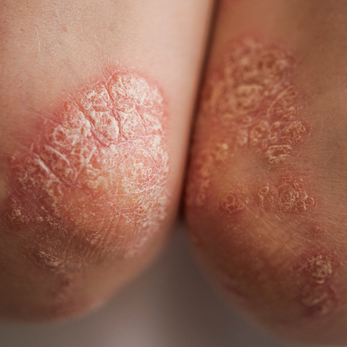 Plaque bei Psoriasis Nahaufnahme
